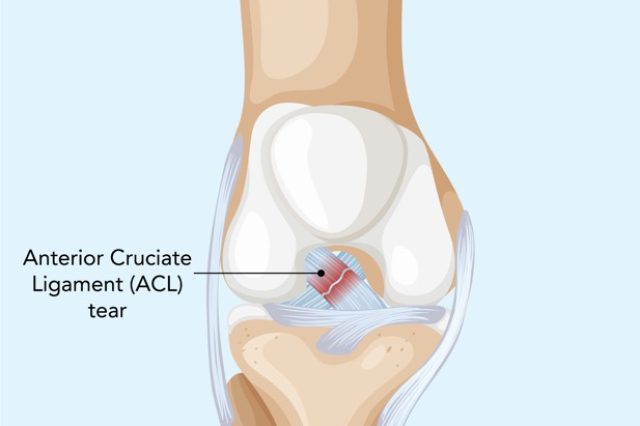 ACL Ligament best orthopaedic hospital in sikar Riddhi siddhi eye and multi speciality hospital