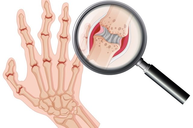 arthritis treatment best orthopaedic hospital in sikar Riddhi siddhi eye and multispeciality hospital